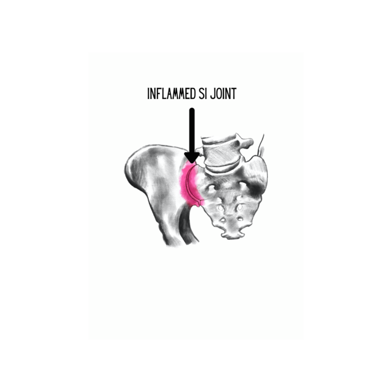 Si Joint Inflamation